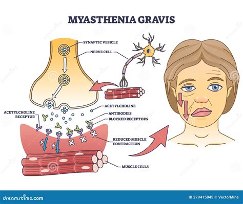 Ilustrácia liečby myasthenia gravis