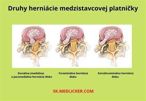 Štruktúra medzistavcovej platničky a herniácia
