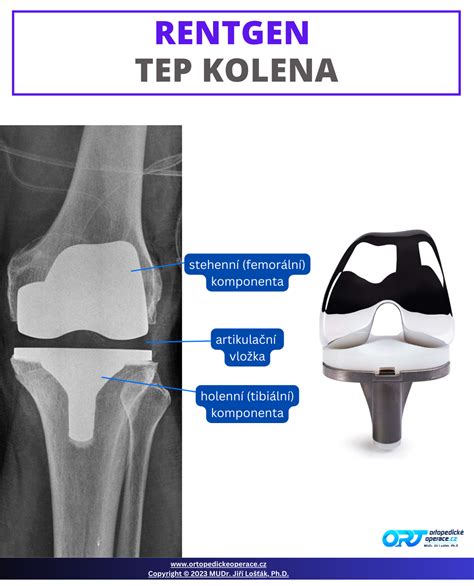 Schéma rehabilitačných cvikov po TEP kolena