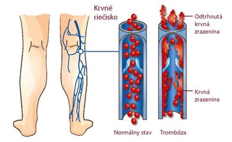 Ilustrácia hlbokej žilovej trombózy