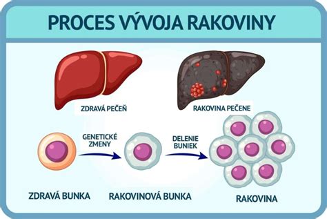 Príznaky detskej rakoviny
