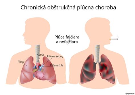 Infografika porovnávajúca zdravé pľúca a pľúca fajčiara