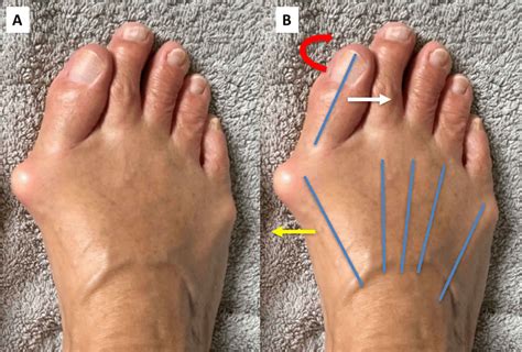 Príčiny vzniku hallux valgus