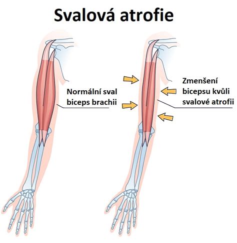 Prehľad typov mozgovej atrofie