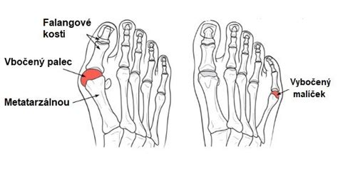 Schéma: Hallux Valgus - vybočený palec na nohe