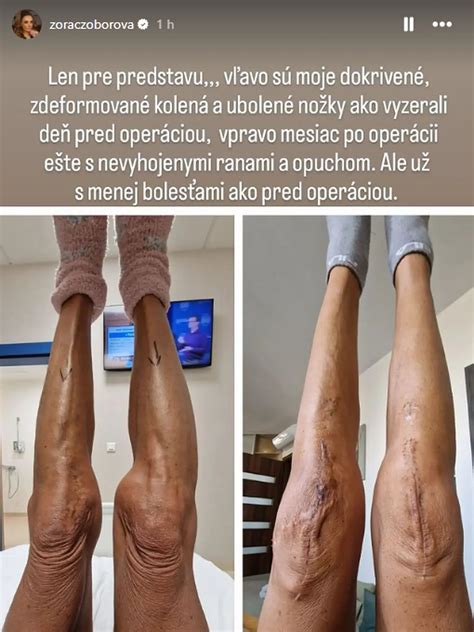 Použitie barlí po operácii kolena