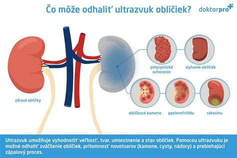 Ilustrácia močového mechúra a katétra