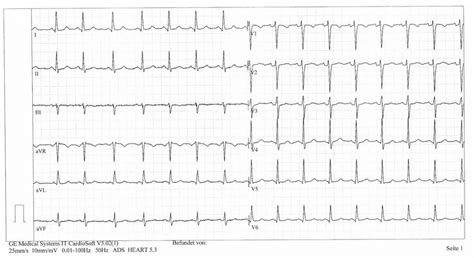 EKG záznam srdca s typickými zmenami pri infarkte myokardu