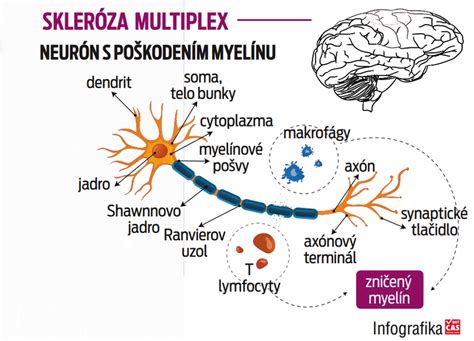 Skleróza multiplex a invalidita
