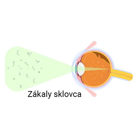 Najčastejšie očné ochorenia vedúce k zrakovému postihnutiu