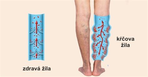 Ilustrácia kŕčových žíl na dolných končatinách