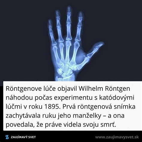 Röntgenová snímka vykĺbeného lakťa