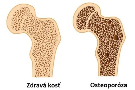 Porovnanie zdravej kosti a kosti s osteoporózou