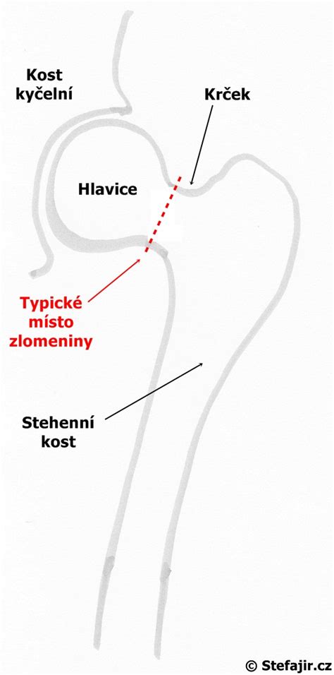Schéma rôznych typov zlomenín krčka stehennej kosti