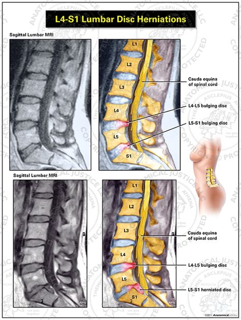 Infografika zobrazujúca najčastejšie miesta hernií (L4-L5, L5-S1)