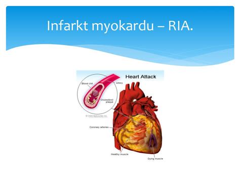 Rizikové faktory infarktu myokardu