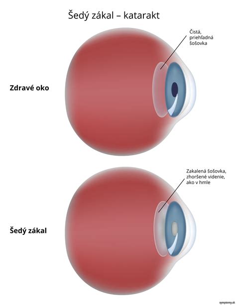 Ilustrácia oka so šedým zákalom