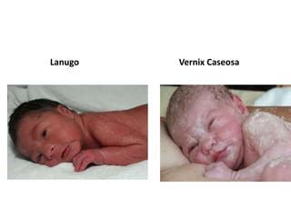 Lanugo a vernix caseosa na pokožke novorodenca