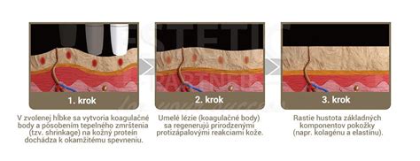 Schéma prieniku ultrazvuku do tkaniva v závislosti od frekvencie