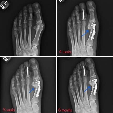 Rentgenový snímok chodidla s Hallux valgus