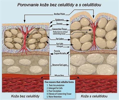 ilustrácia štruktúry pokožky s celulitídou