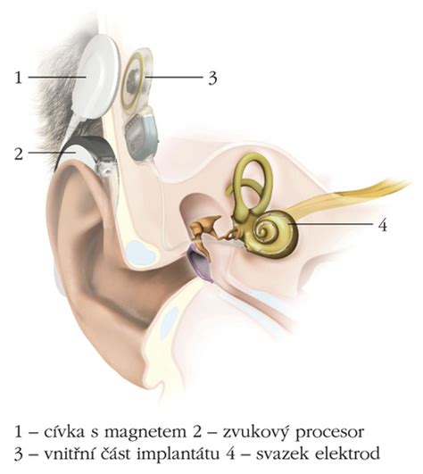 Schéma kochleárneho implantátu a jeho umiestnenia v uchu