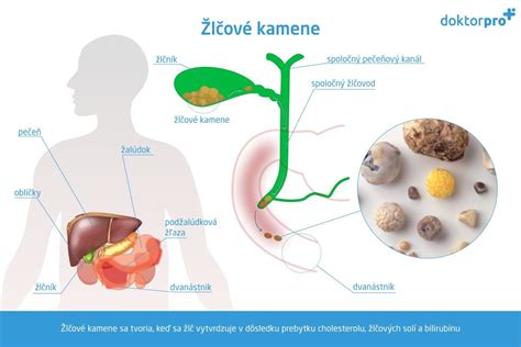 Schéma: Žlčník a žlčové cesty s vyznačenými kameňmi