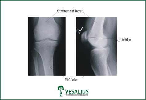 RTG snímka kolenného kĺbu s artrózou
