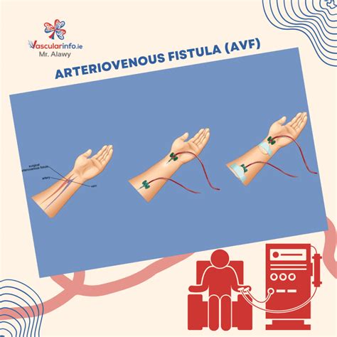 Nákres arteriovenóznej fistuly