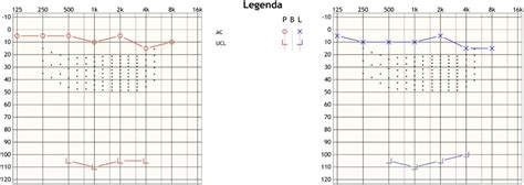 Príklad audiogramu