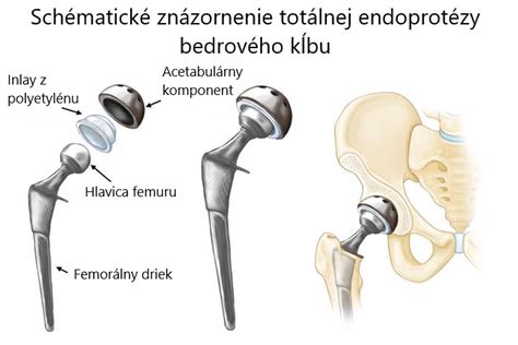Zoznam pomôcok pre domácnosť po operácii bedrového kĺbu