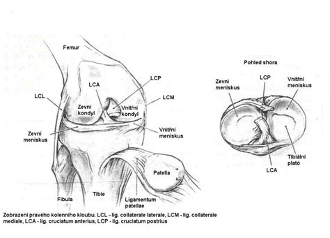 Anatomická kresba kolenného kĺbu s vyznačením Osgood-Schlatterovej lézie