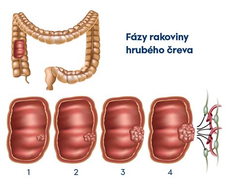 Ilustrácia hrubého čreva s vyznačenými polypmi
