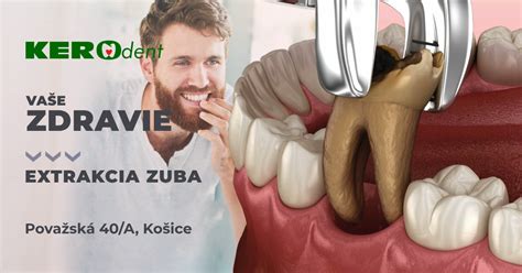 Ilustrácia postupu extrakcie zuba