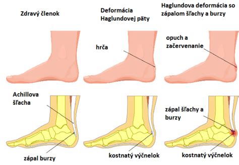 Anatomické odchýlky chodidla a ich vplyv na pätovú ostrohu