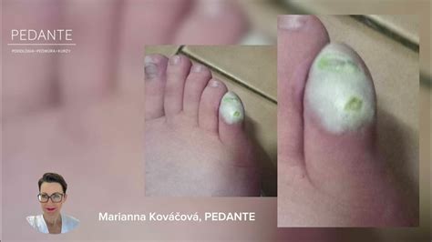 Rozdiel medzi nechtami na rukách a nohách