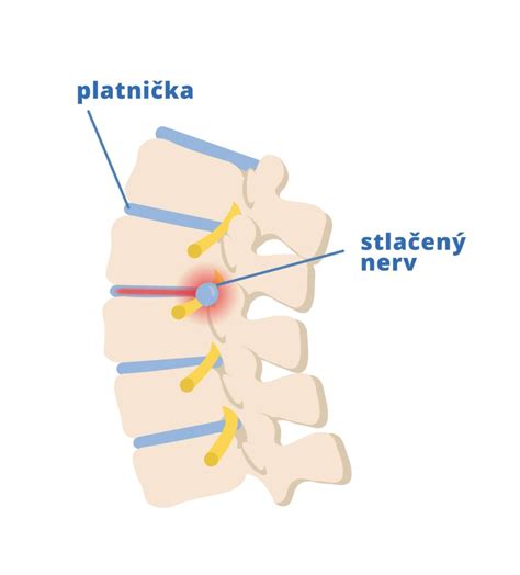 Ilustrácia chrbtice s medzistavcovými platničkami