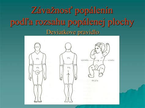 Rozdelenie popálenín podľa hĺbky