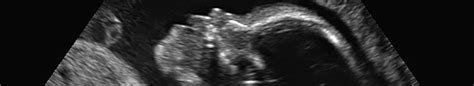Metódy prenatálnej diagnostiky Downovho syndrómu