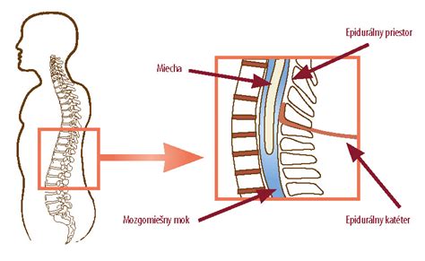 Ilustrácia epidurálnej analgézie počas pôrodu