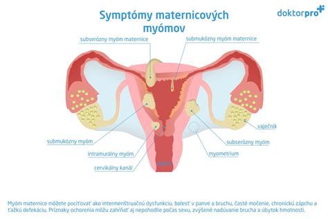 Ilustrácia maternicových myómov a endometriózy.