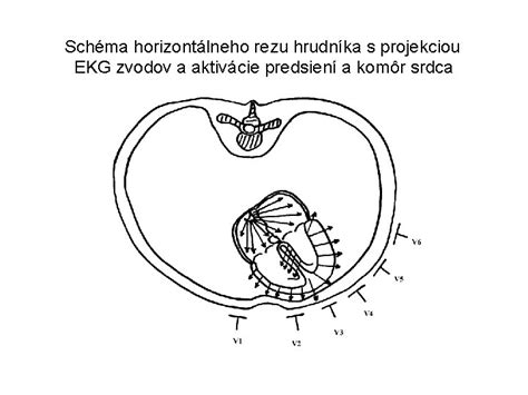 Schéma chirurgického rezu pri abdominálnej hysterektómii.