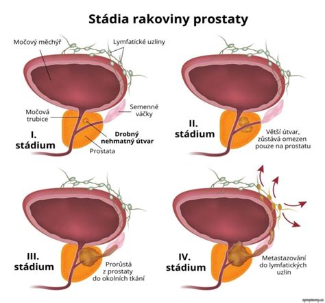Typy rakoviny močového mechúra