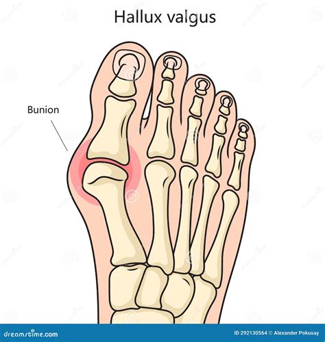 Schéma príčin Hallux Valgus