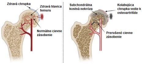 Schéma avaskulárnej nekrózy bedrového kĺbu