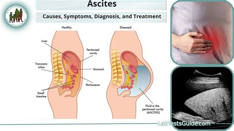 Ascites