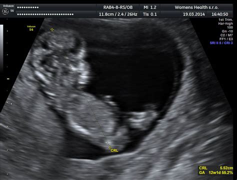 ultrazvukové vyšetrenie plodu v druhom trimestri