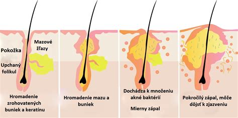 Infografika: Vznik akné - hyperseborea, hyperkeratóza, baktérie
