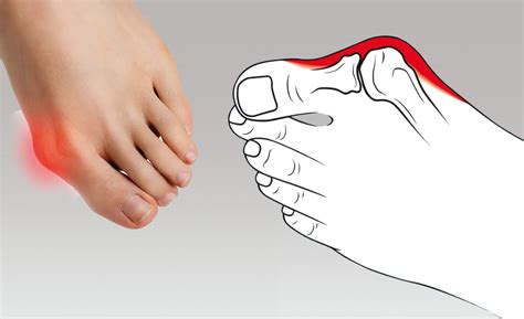 Ilustrácia rôznych typov nevhodnej obuvi spôsobujúcej Hallux Valgus