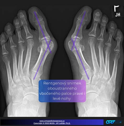 Schéma chirurgického zákroku na korekciu Hallux Valgus